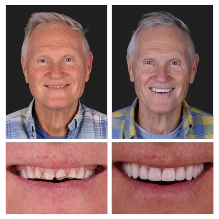Teeth Before & After