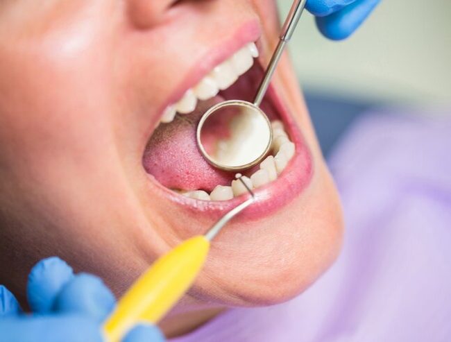 Tooth Extractions in Lakewood Ranch