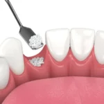 Bone Grafting