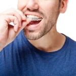 Clear Aligners