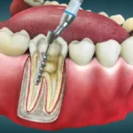 Root Canals