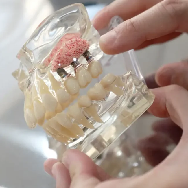 Bone Grafting Bradenton, FL