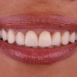 Teeth Smiling 8