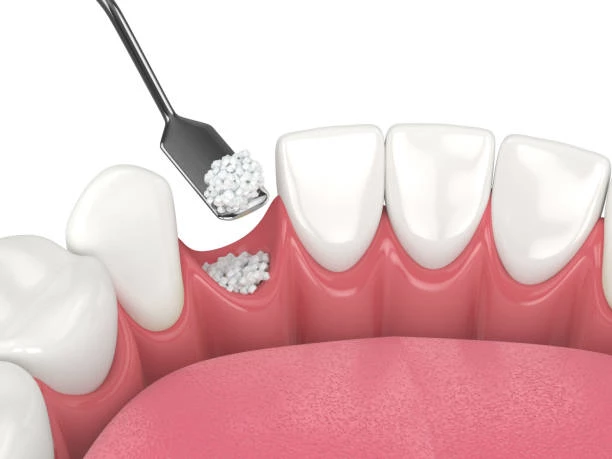 Dental procedure with bone grafting material