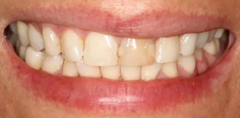 Filling-Front-Tooth-1024x1024