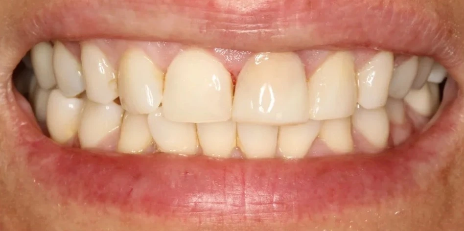 Filling-Front-Tooth-1024x1024 2