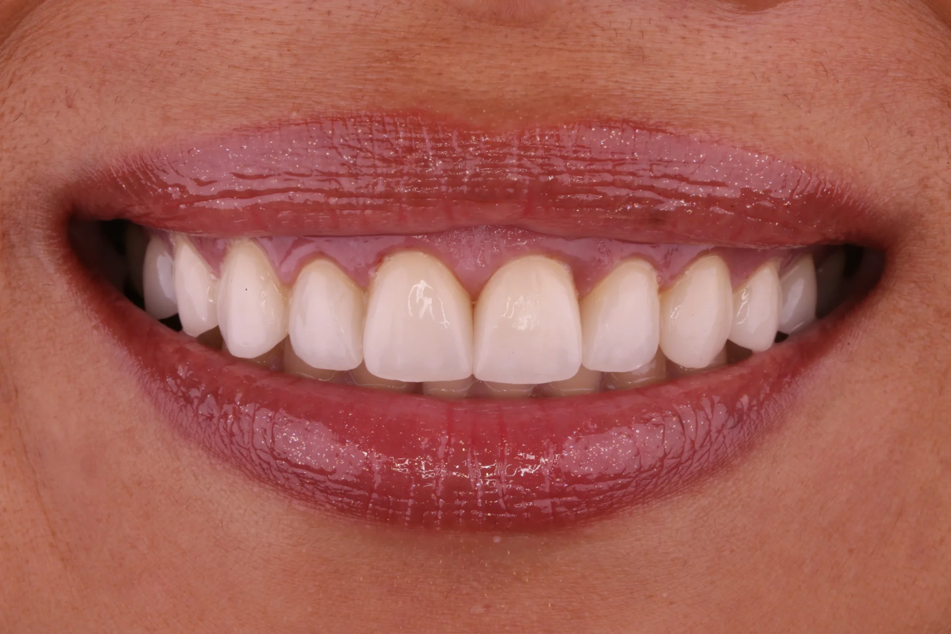 Veneers 3