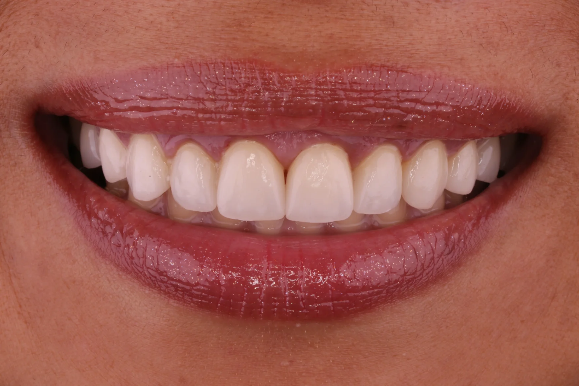Veneers 4