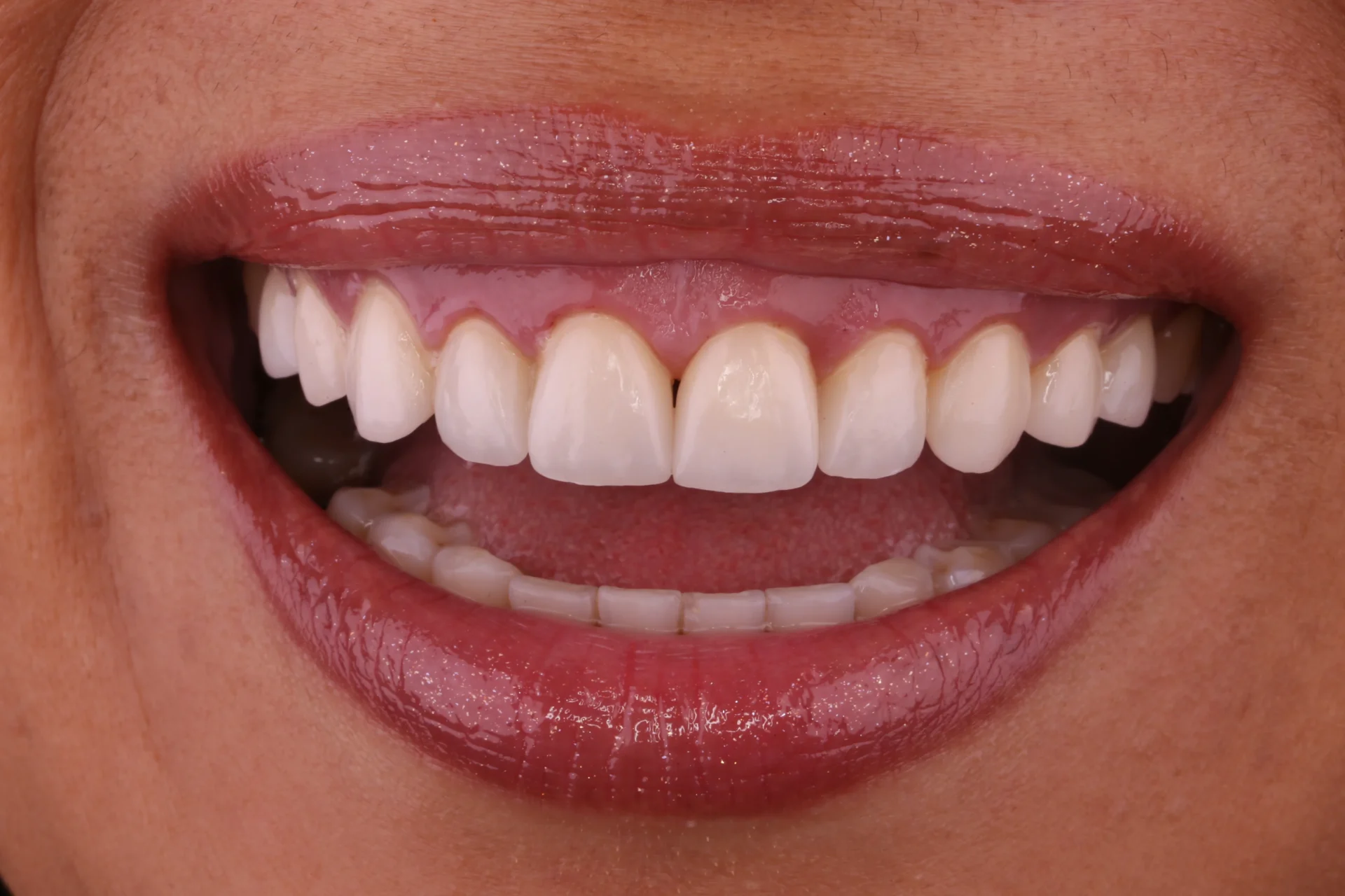 Veneers 5