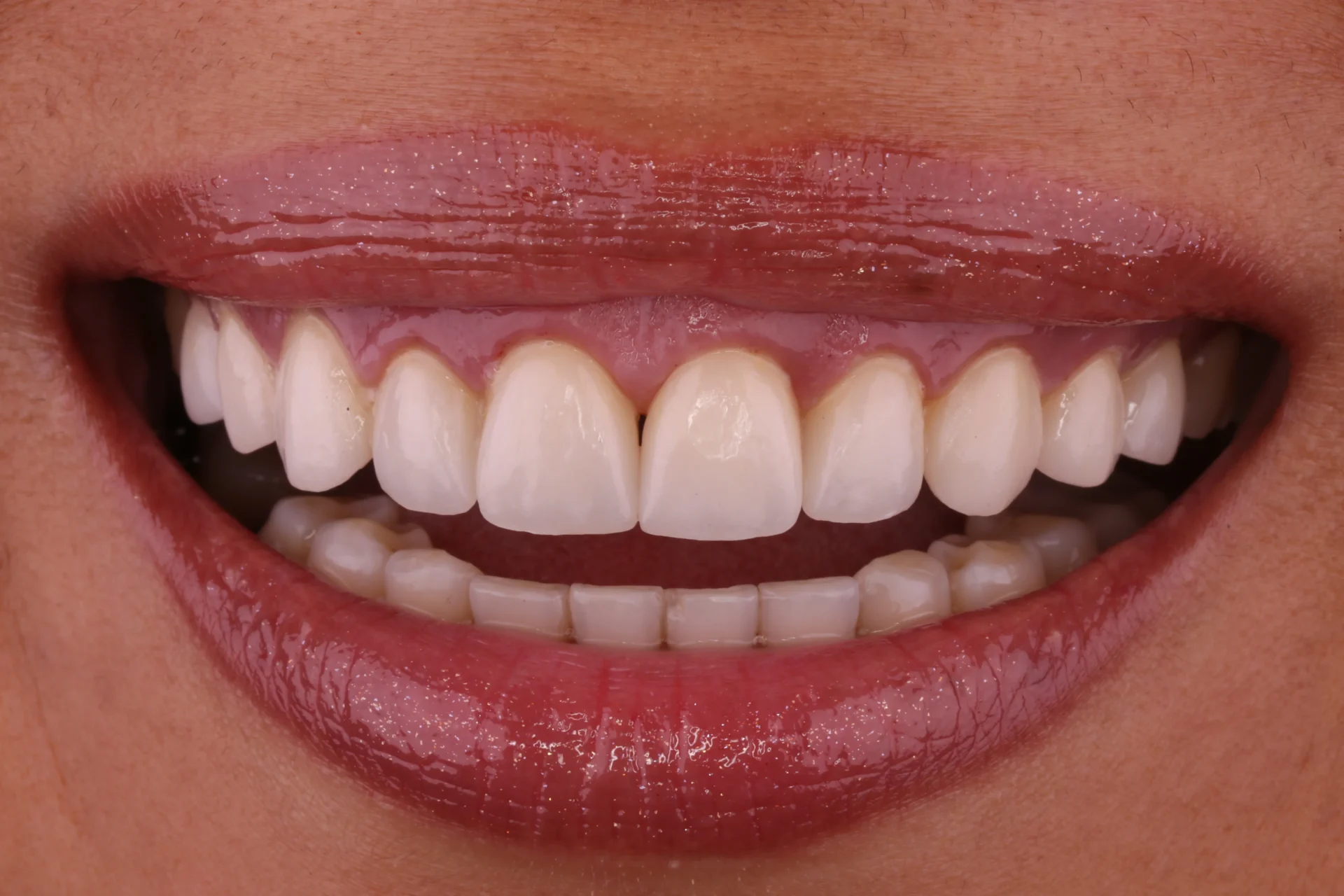 Veneers 6