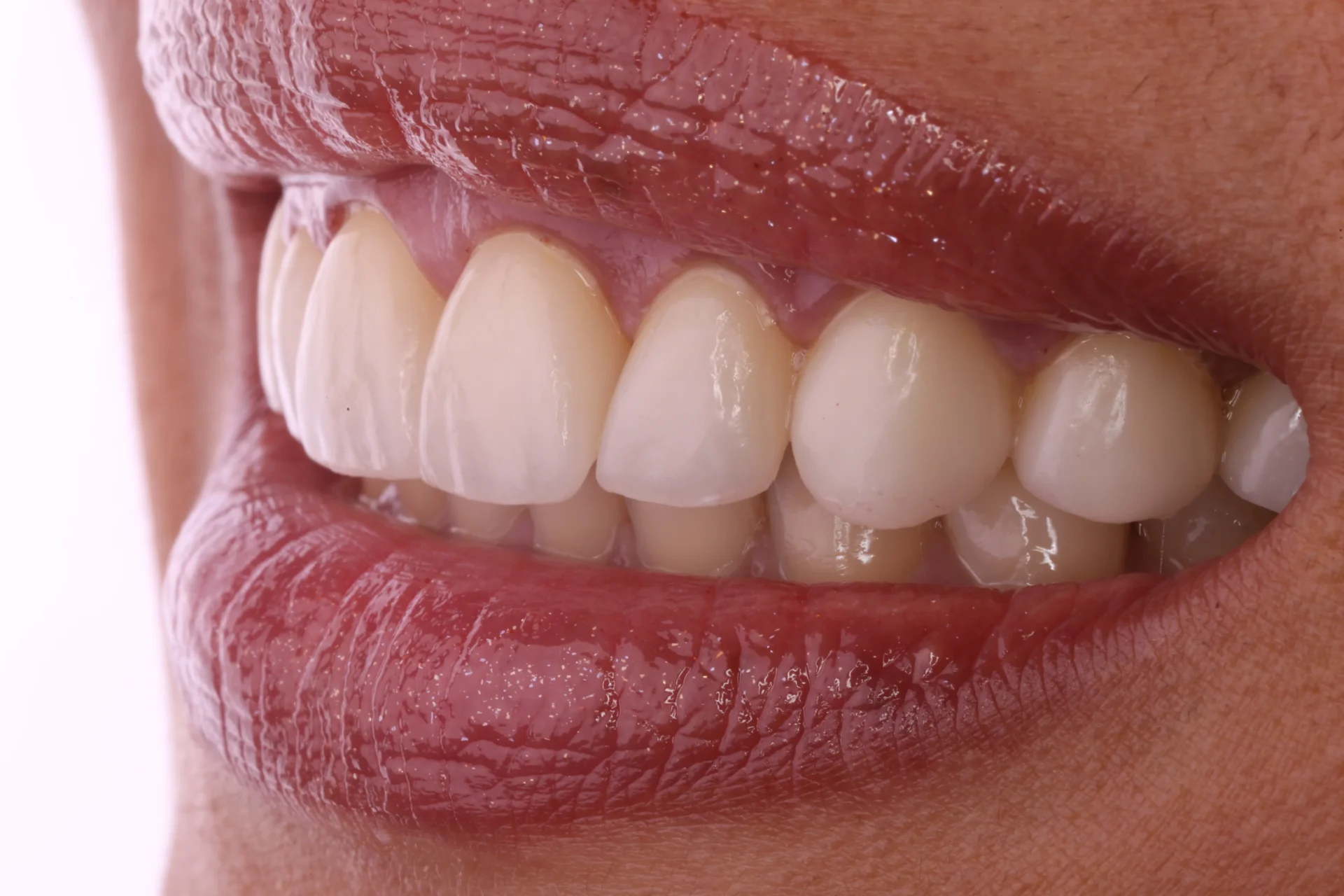 Veneers 7