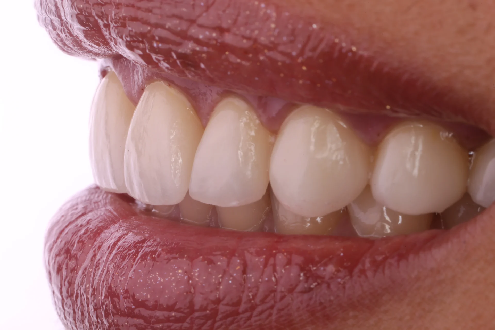 Veneers 8