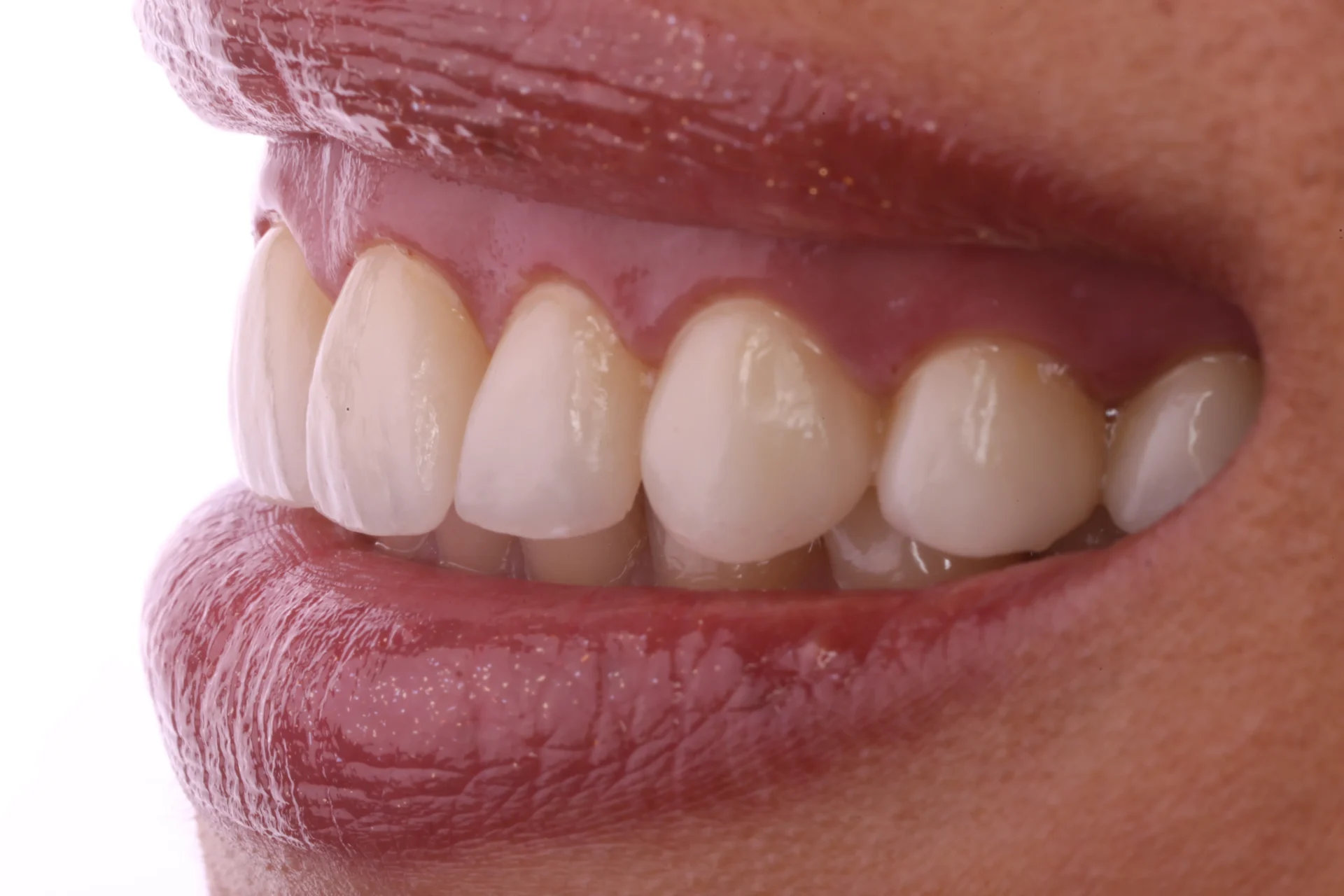 Veneers 9