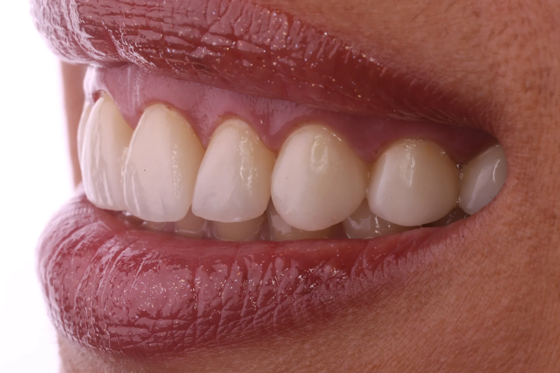 Veneers 10