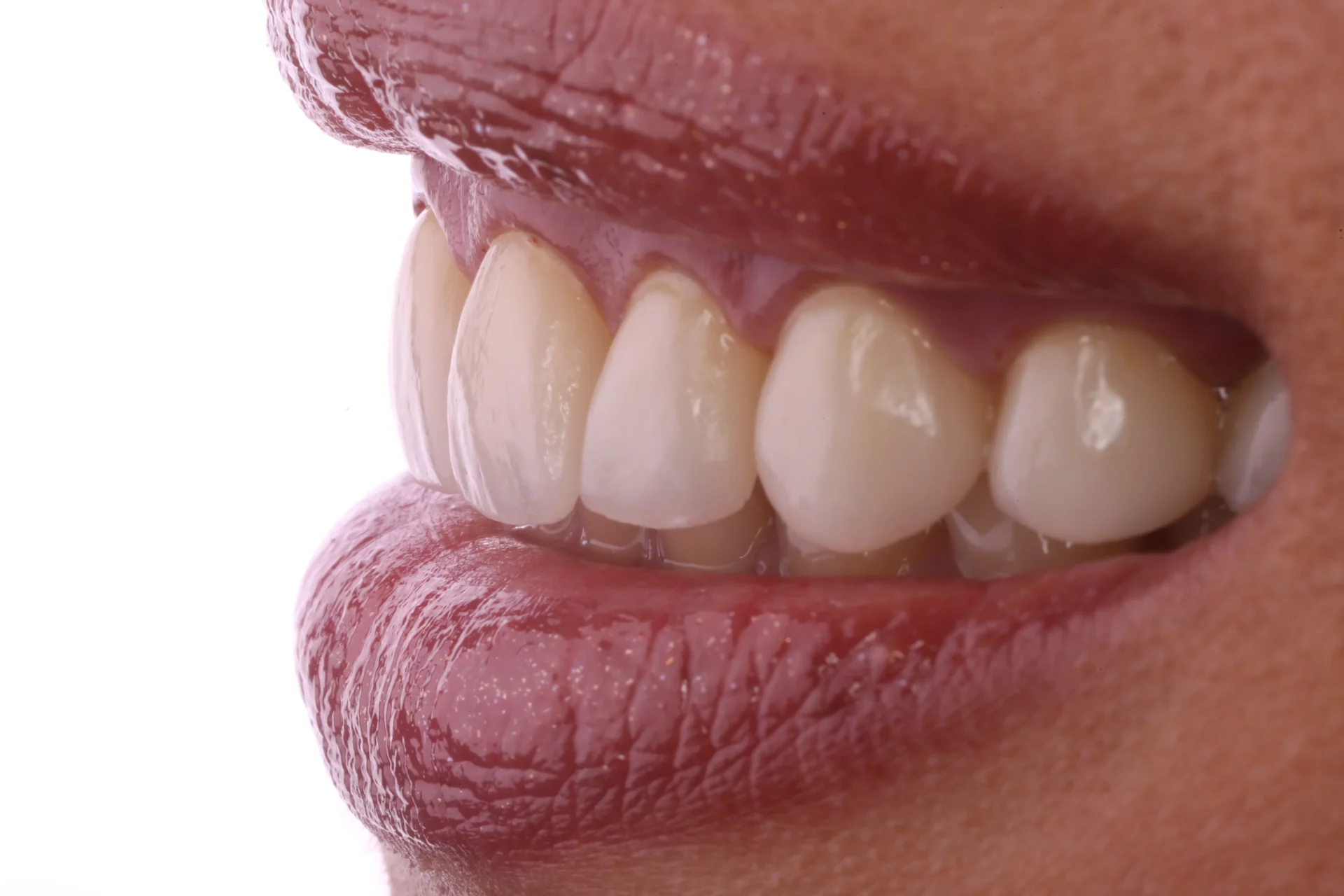 Veneers 11