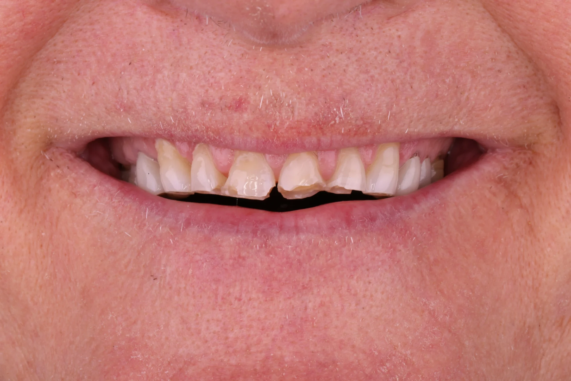 Teeth Before 2