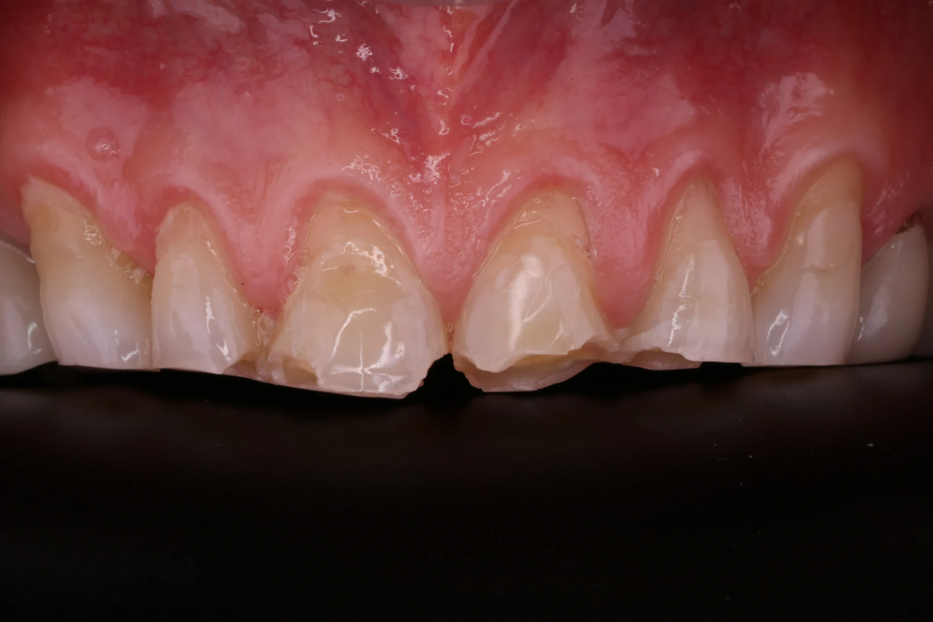 Teeth Before 3