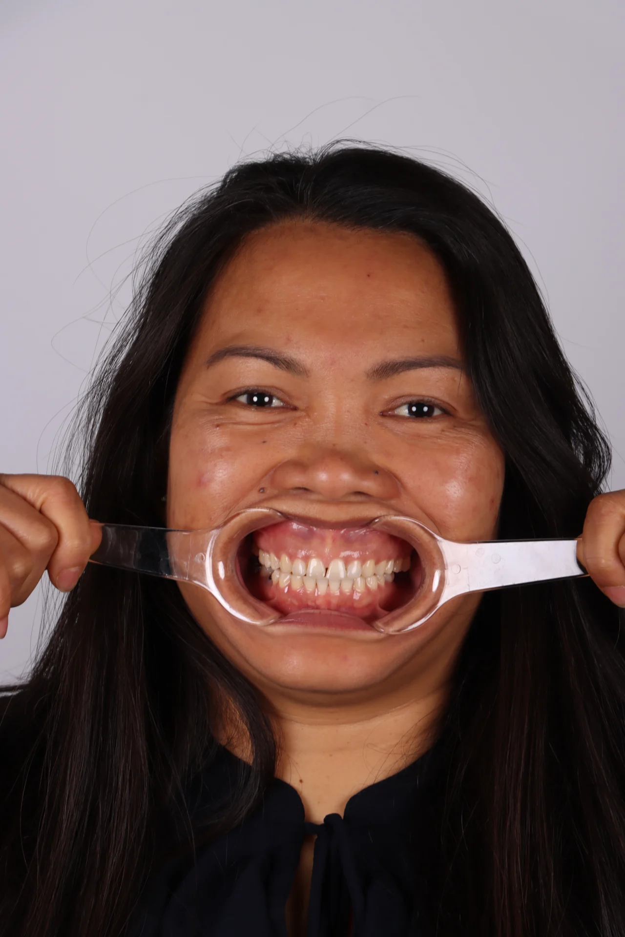 Teeth Before 5