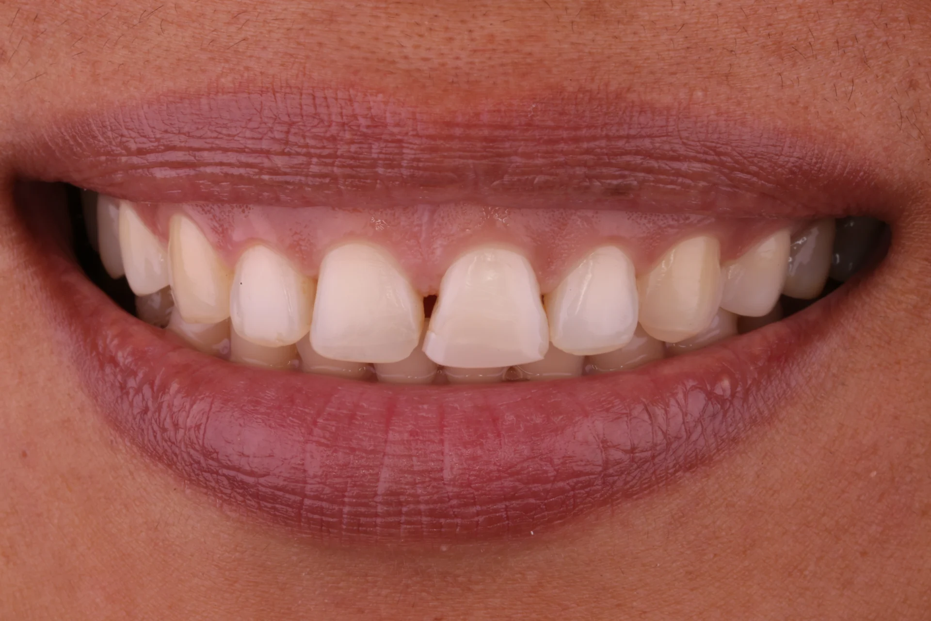 Teeth Before 5