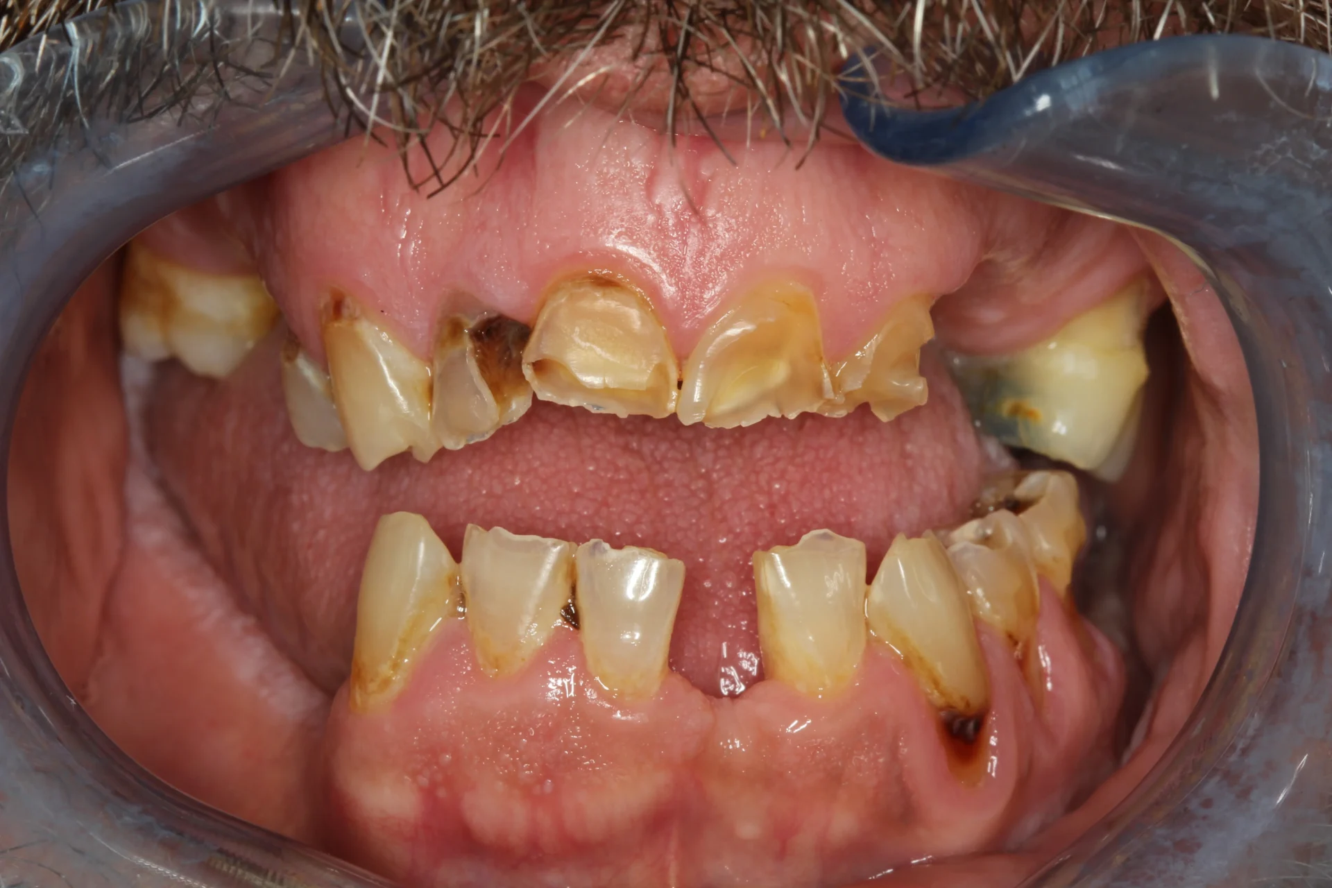 Tooth decay