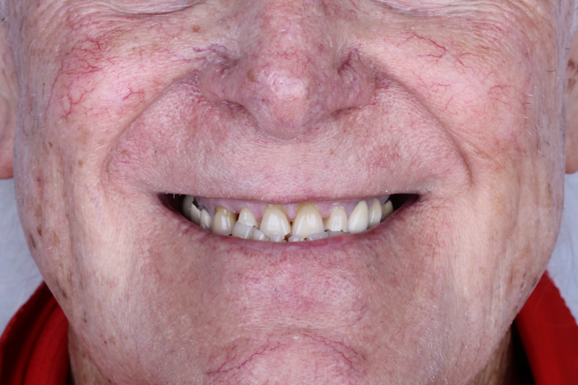 Close up Teeth Before 8