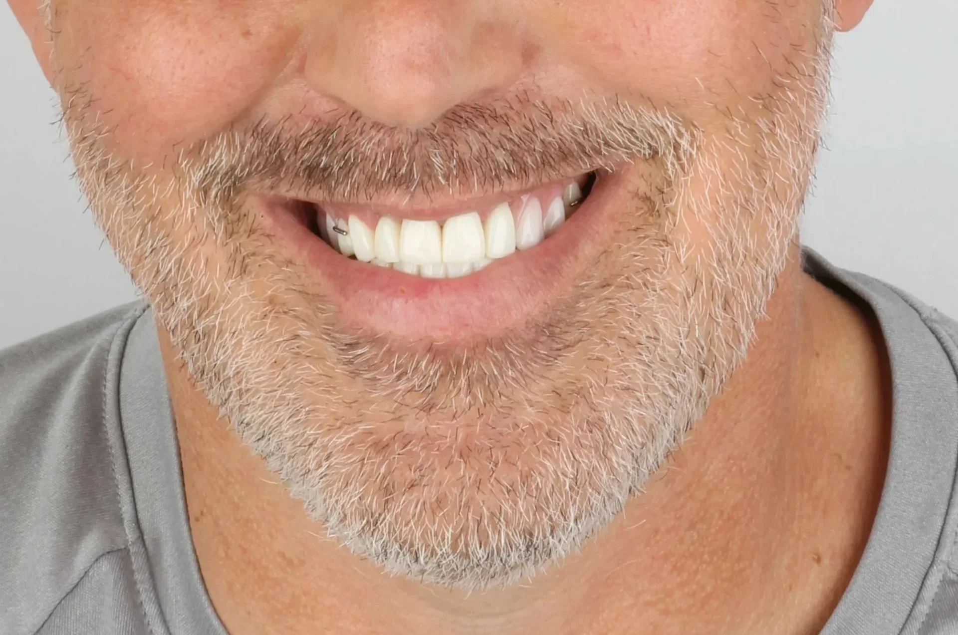 dental Implants 2