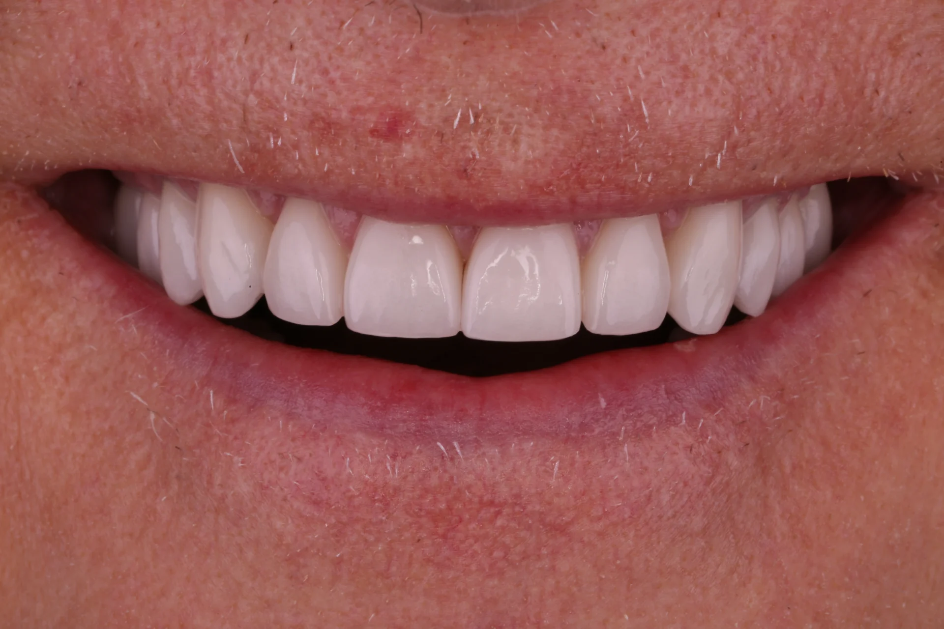 Dental Crowns