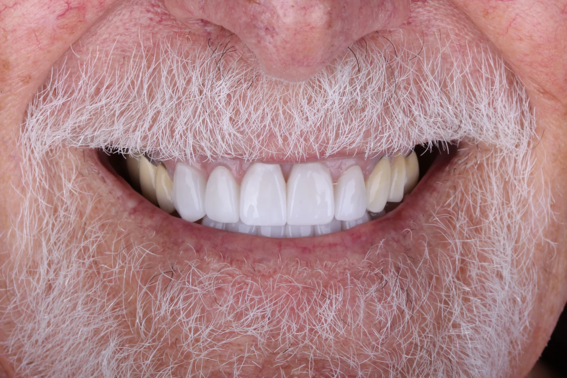 Veneers 8