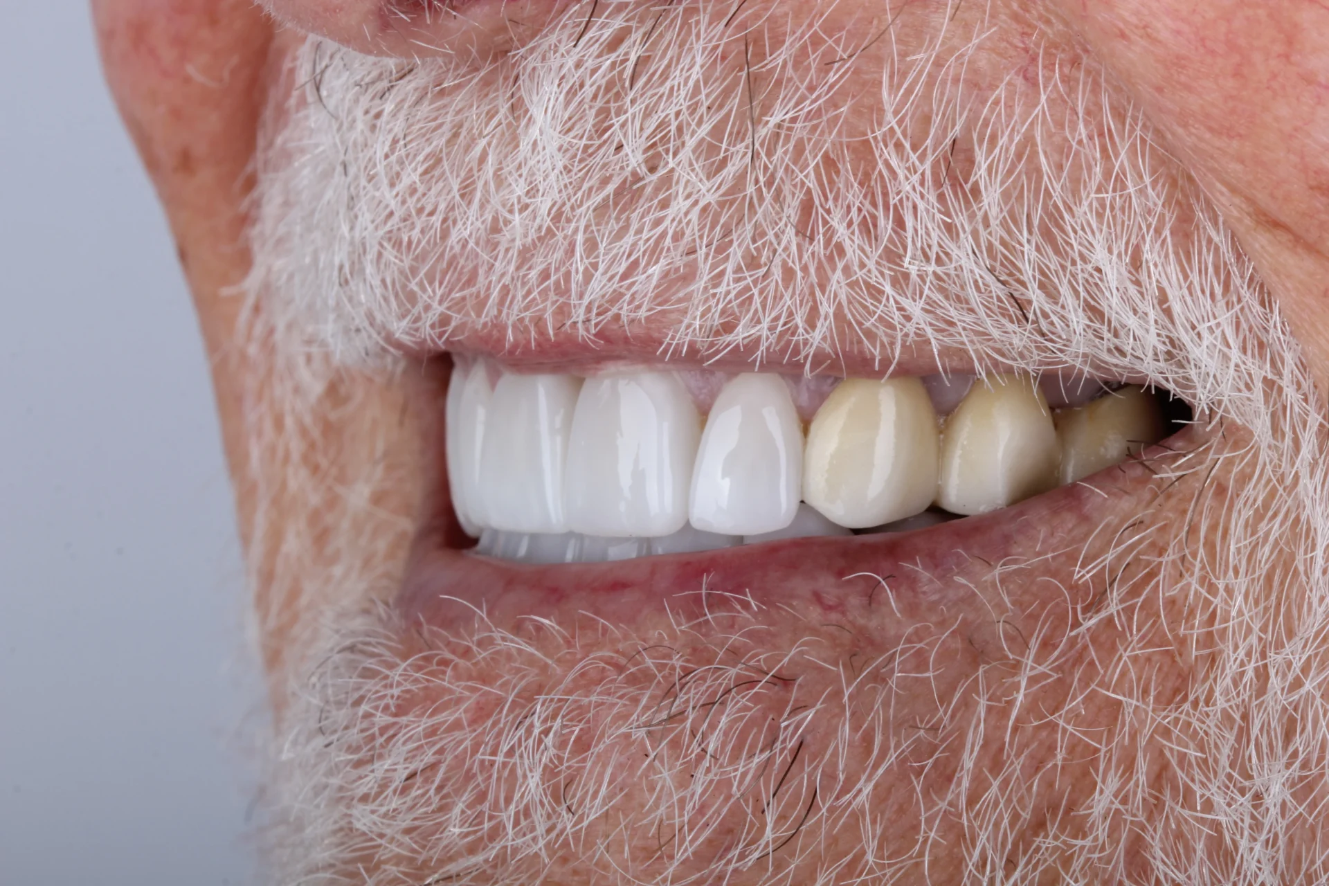 Close-up of white teeth and beard 2