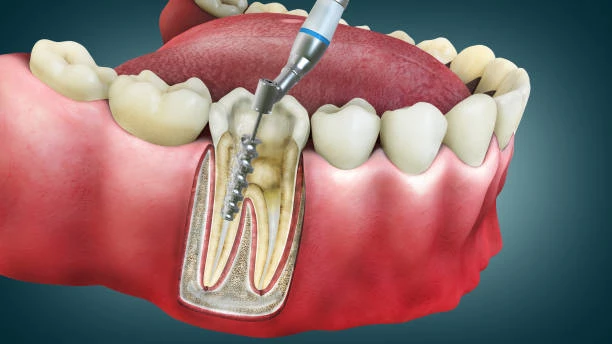 Dental procedure illustrating root canal treatment