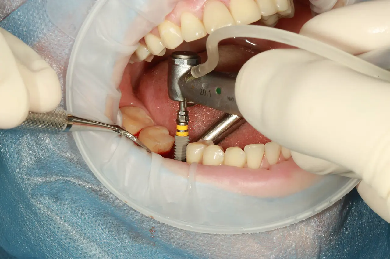 Dental procedure with implant placement