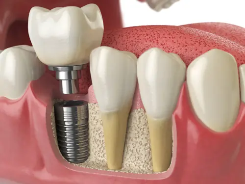 Dental implant cross-section illustration.